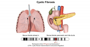 Cystic Fibrosis